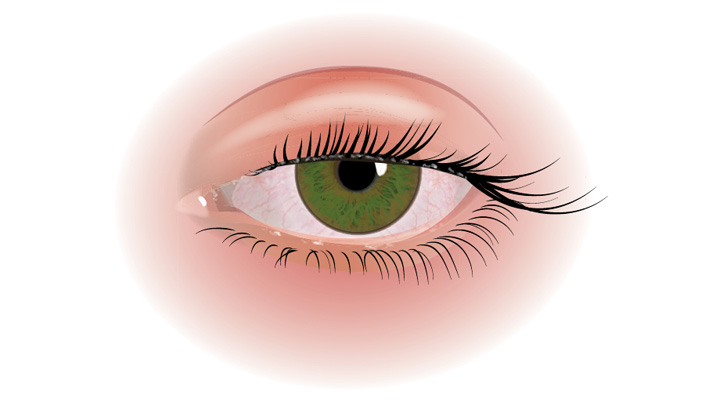 Blefaritis maakt de ooglidranden rood, geïrriteerd en gezwollen.