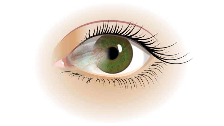 Een pterygium ziet eruit als een roodachtige driehoek die op het oogwit groeit.