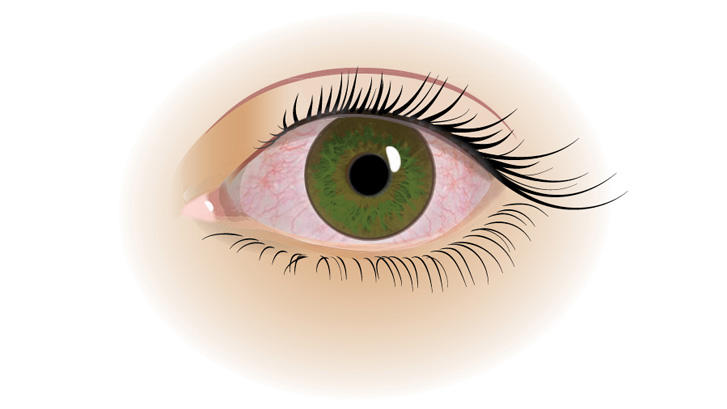 Droge ogen zijn vaak vermoeid, geïrriteerd en tranend.