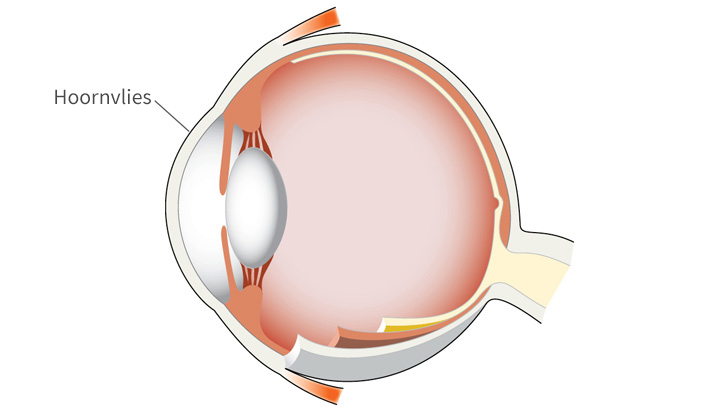 Hoornvlies